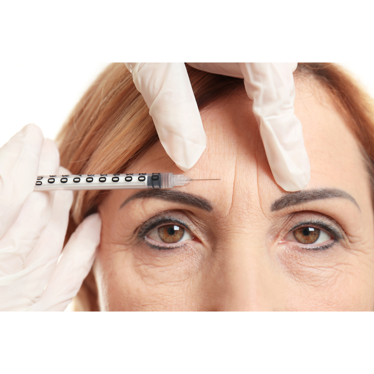 Aplicação de Botox na testa para suavizar linhas de expressão.