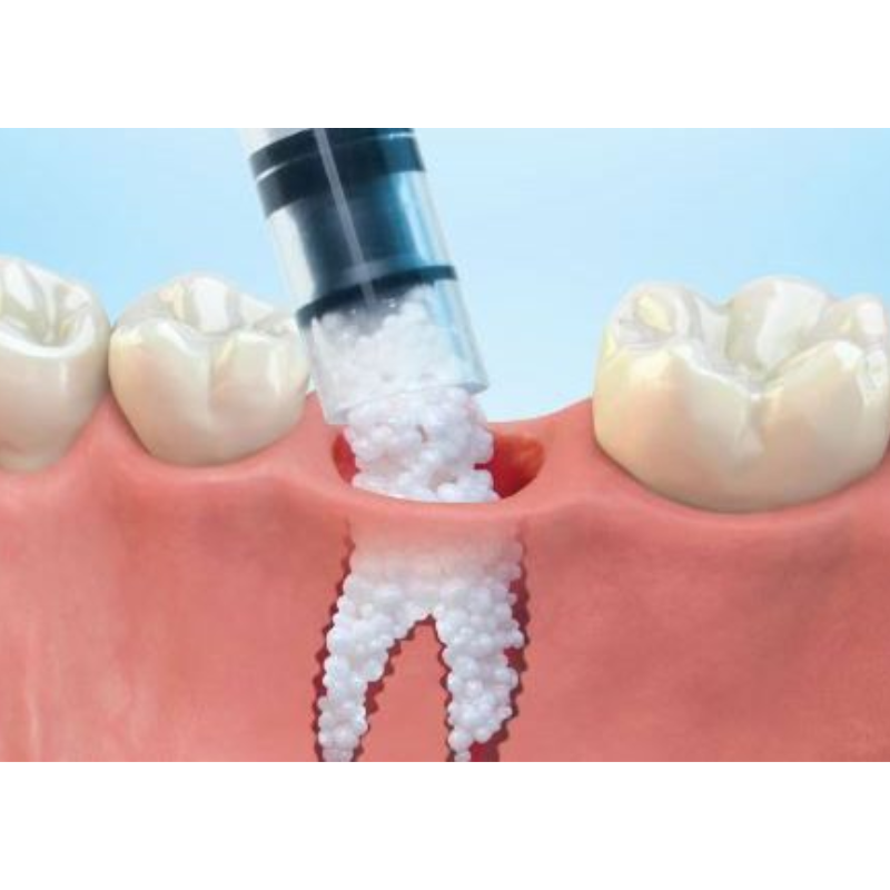 Ilustração de procedimento de enxerto ósseo, preenchendo o alvéolo dental com biomaterial.