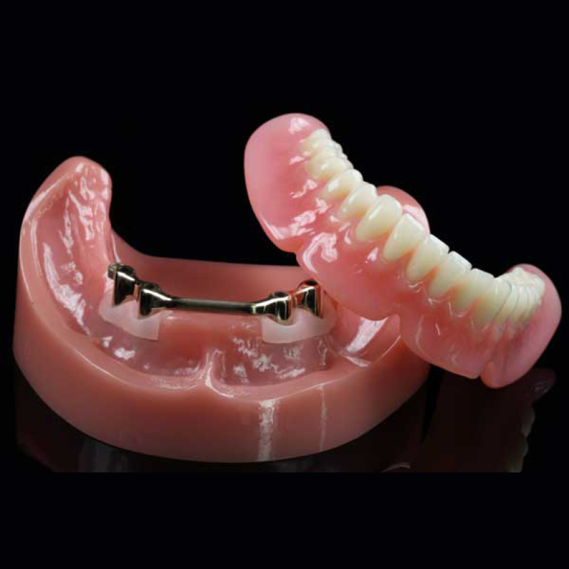 Overdenture