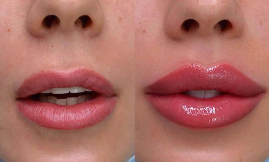 Antes e depois de procedimento de preenchimento labial com aumento de volume.
