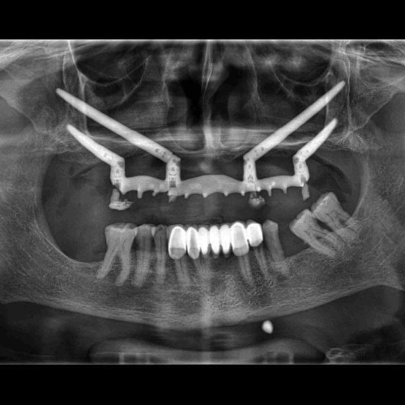 Radiografia panorâmica mostrando implantes zigomáticos fixados no osso zigomático para reabilitação oral.