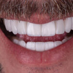 Sorriso depois