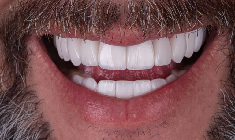 Sorriso depois