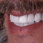 Sorriso depois