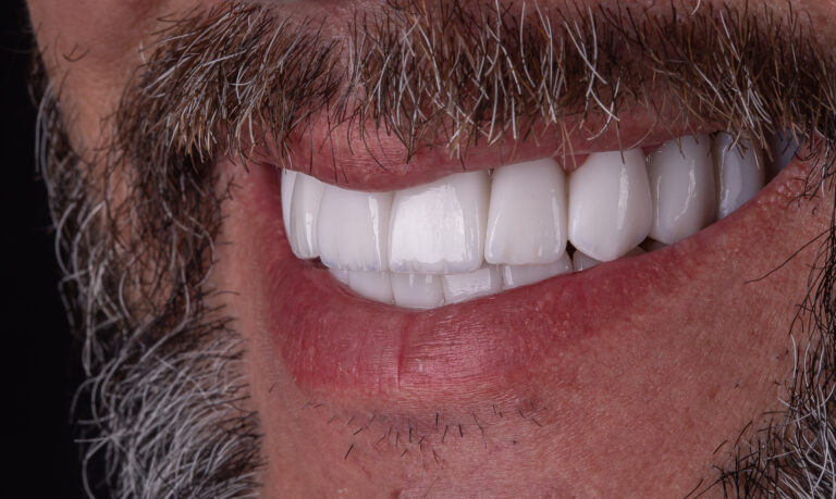 Sorriso depois