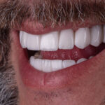 Sorriso depois