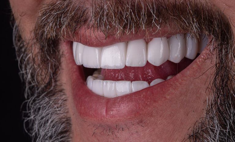 Sorriso depois