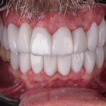 Sorriso depois