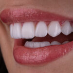 Sorriso da Larissa do BBB