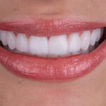 Sorriso da Larissa do BBB depois