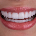 Sorriso da Larissa do BBB
