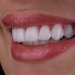 Sorriso da Larissa do BBB