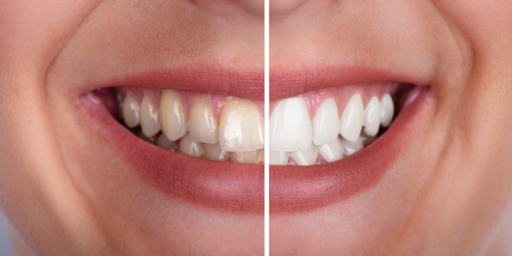 Antes e depois do clareamento dental na Lapa realizado na 24K Odontologia Estética. Dentes visivelmente mais brancos e saudáveis