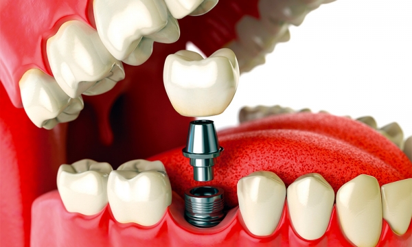 Instalação de Implantes em dente faltando.