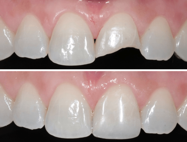 Antes e depois de uma Restaurações Dentárias na Lapa na 24K Odontologia Estética. Dente quebrado restaurado com material estético para um resultado natural.