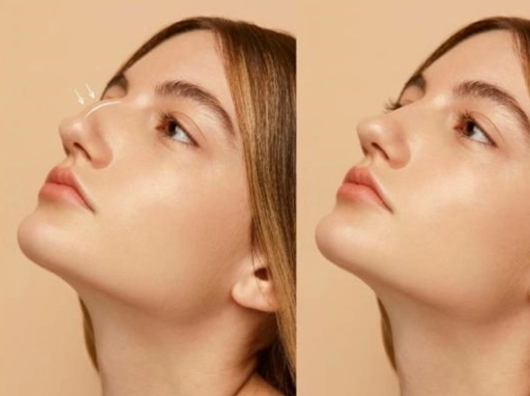 Antes e depois de uma rinomodelação em mulher jovem, mostrando correção e harmonização do contorno nasal com um procedimento estético minimamente invasivo.